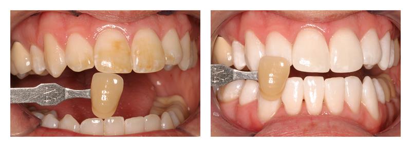 how to remove discoloration of teeth