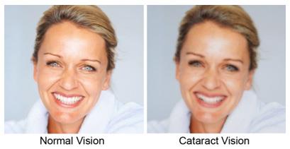 Vision After Cataract Surgery, Elmquist Eye Group